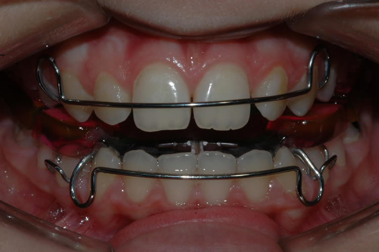 Elastici e apparecchio ortodontico - Studio Dentistico Malara